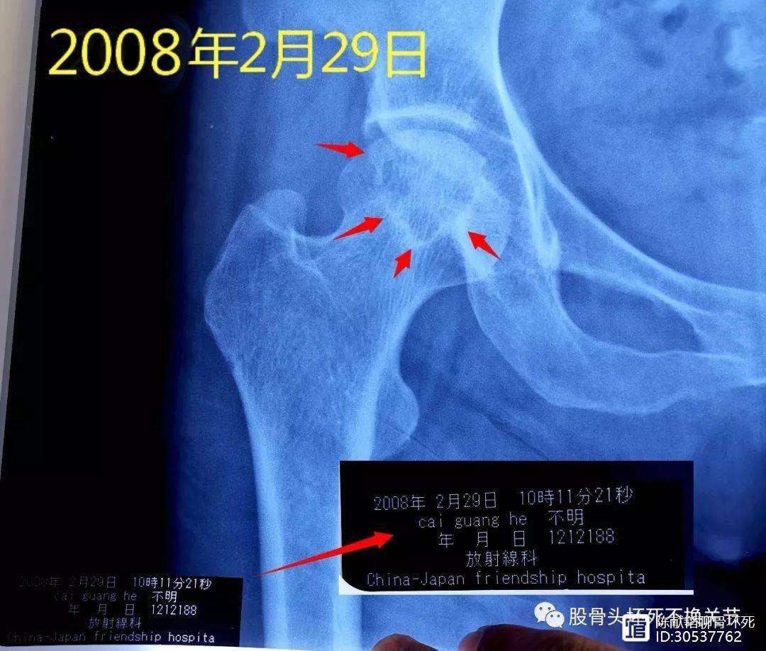 安阳人工骨头医保报销多少(人工骨头医保报销多少比例)
